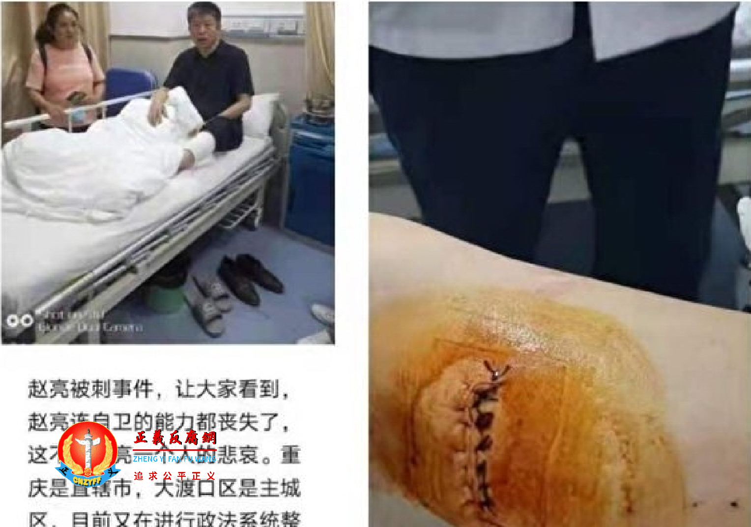 重庆访民赵亮被埋伏在小区门后的三个维稳人员殴打刺伤小腿，缝了三层共计40余针。.png