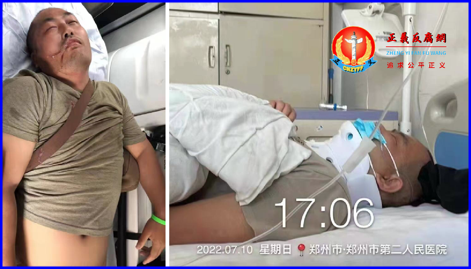 7月10日警民冲突当中，一名储户被打到颈部骨折，目前在郑州市第二医院，昏迷未醒。.png